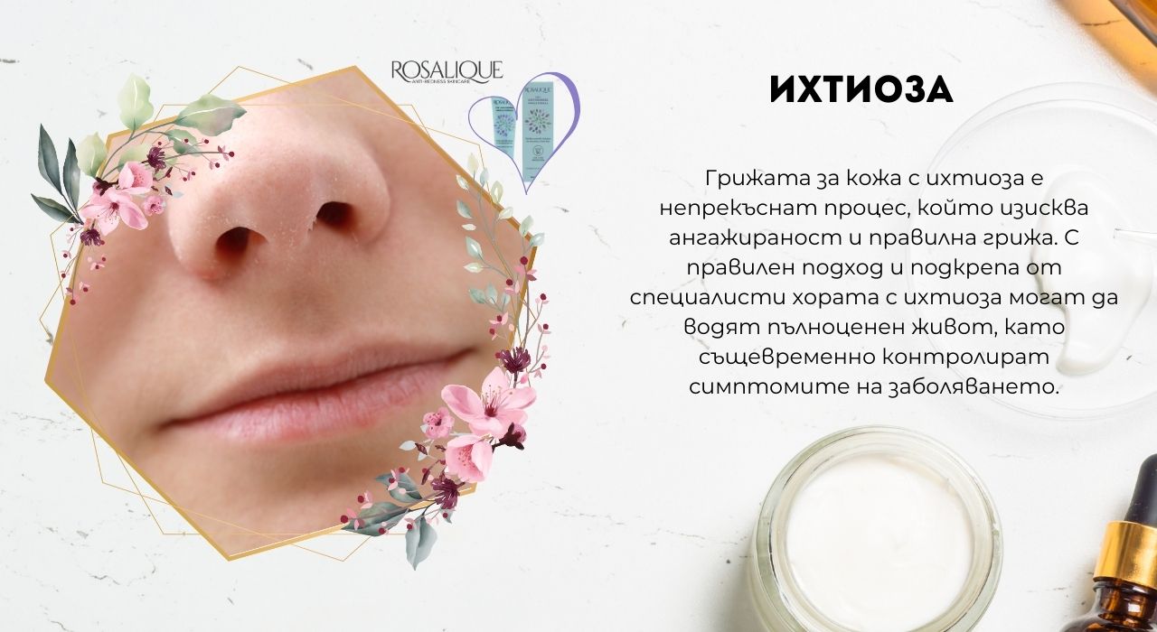 Ихтиоза - как да предпазим кожата?