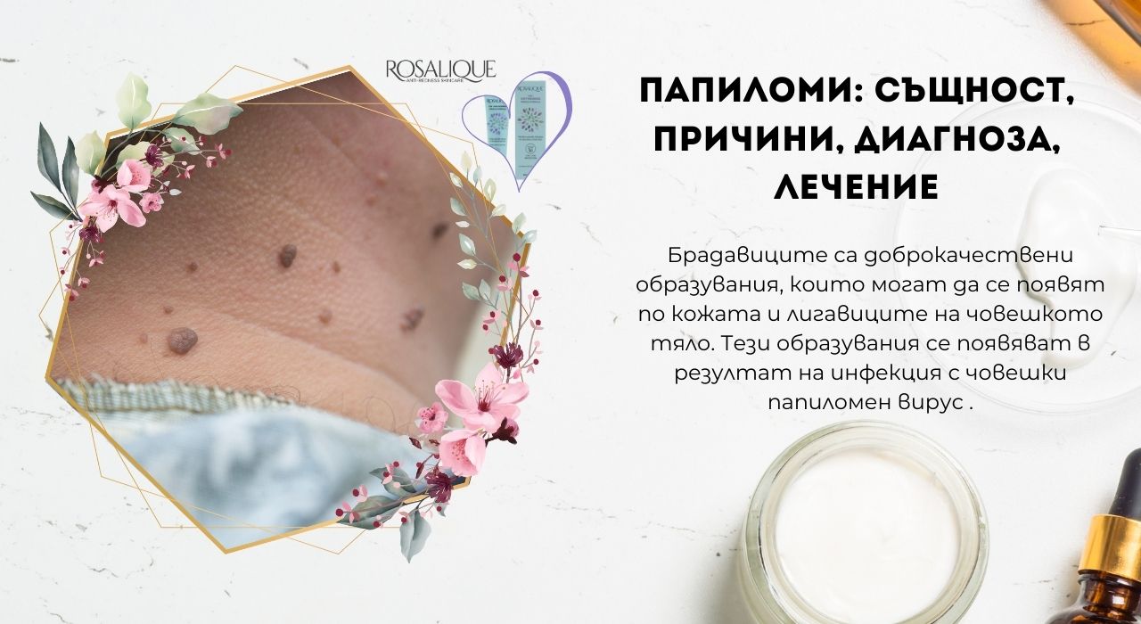 Папиломи: същност, причини, диагноза, лечение