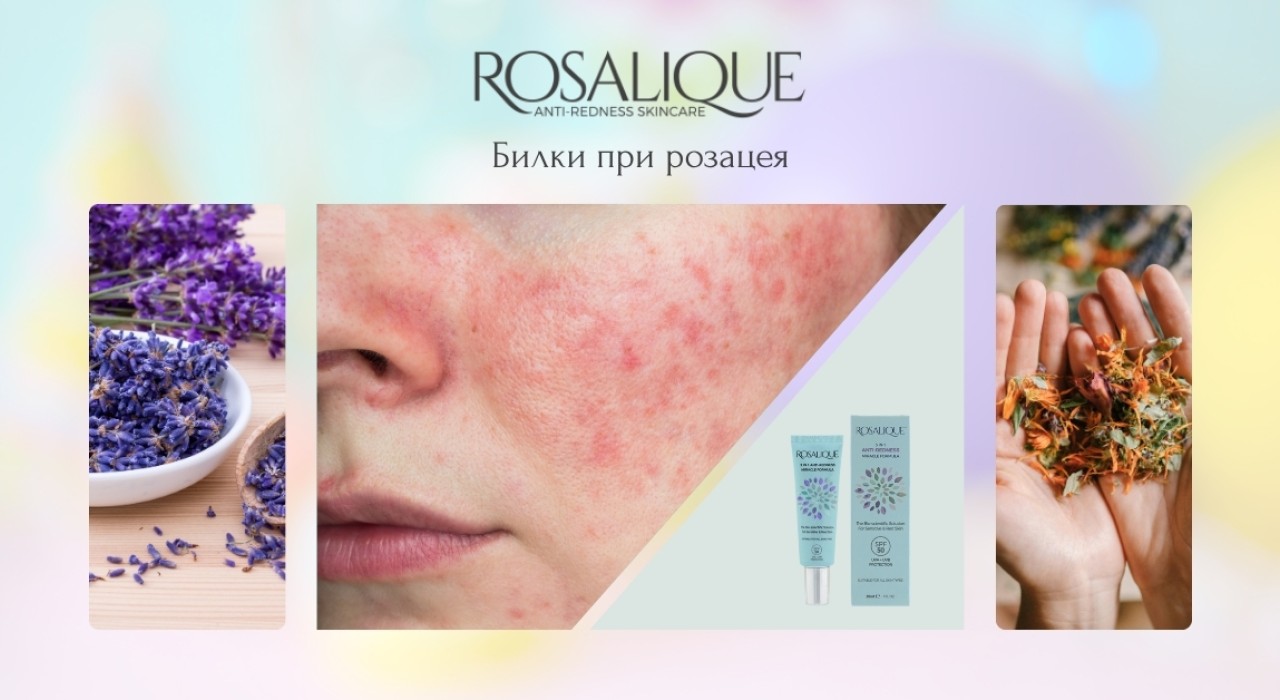 Билки при розацея