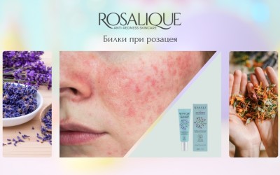 Билки при розацея