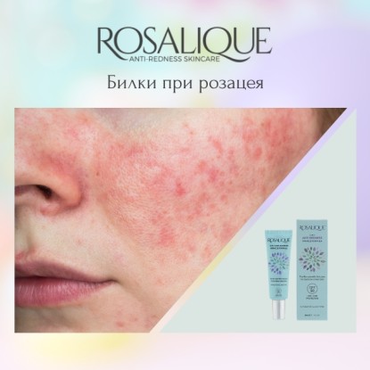 Билки при розацея